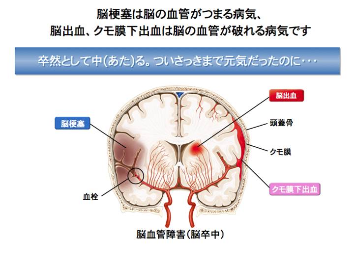 梗塞 脳 アテローム 性 血栓