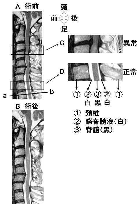 後方椎弓拡大術1