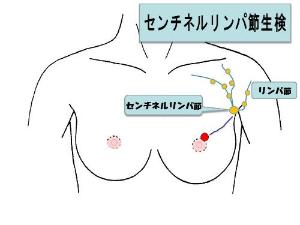 1センチネルリンパ節生検.jpg
