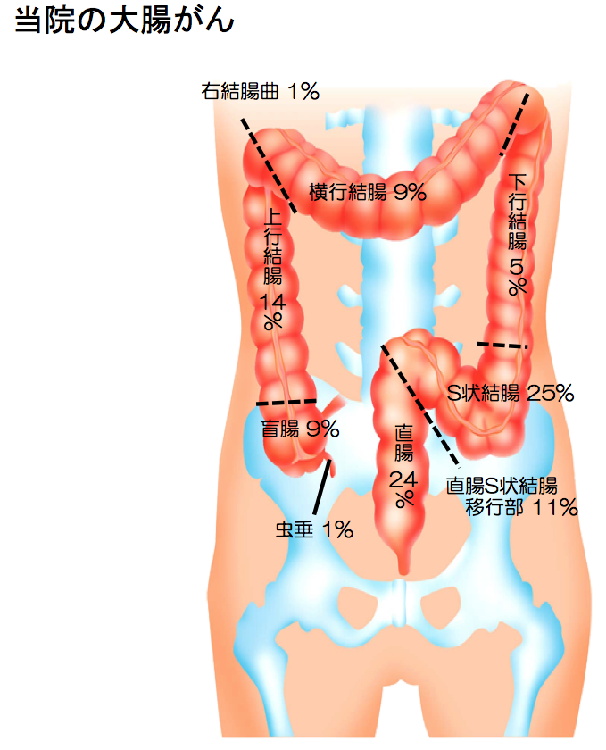 大腸がん
