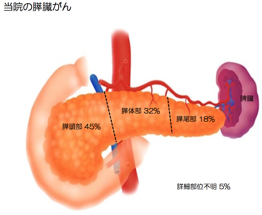 膵臓がん