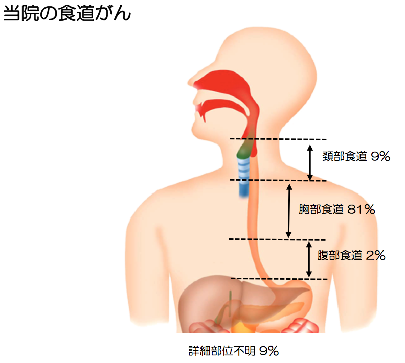 食道がん