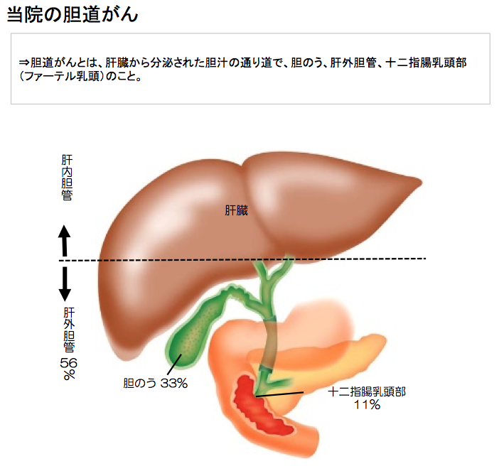 胆道がん