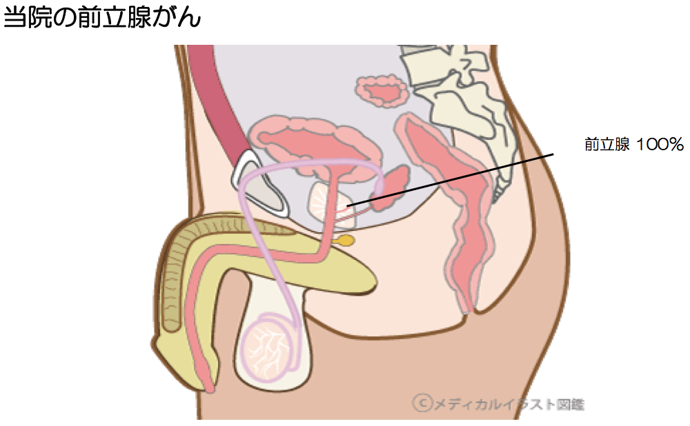 前立腺がん