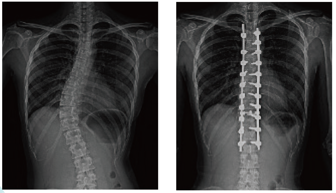 写真　側弯側弯矯正固定術